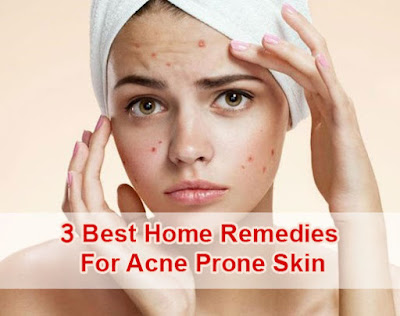 3 Best Home Remedies For Acne Prone Skin