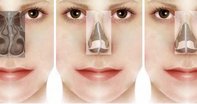 Тампоны в нос после операции. Септопластика носа исправление перегородки. Септопластика носовой перегородки операция. Септопластика искривление носовой перегородки. Ринопластика исправление перегородки.