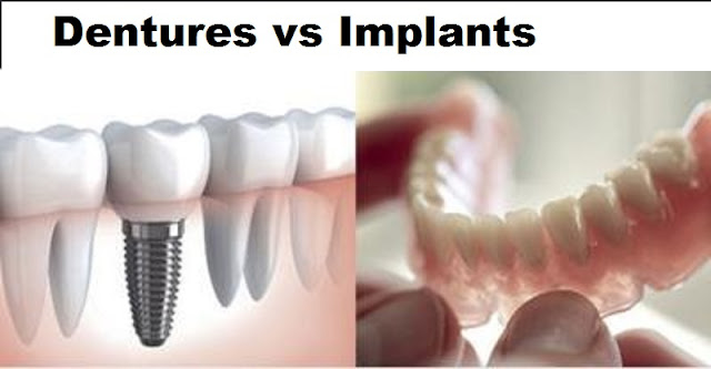 Dentures And Implants