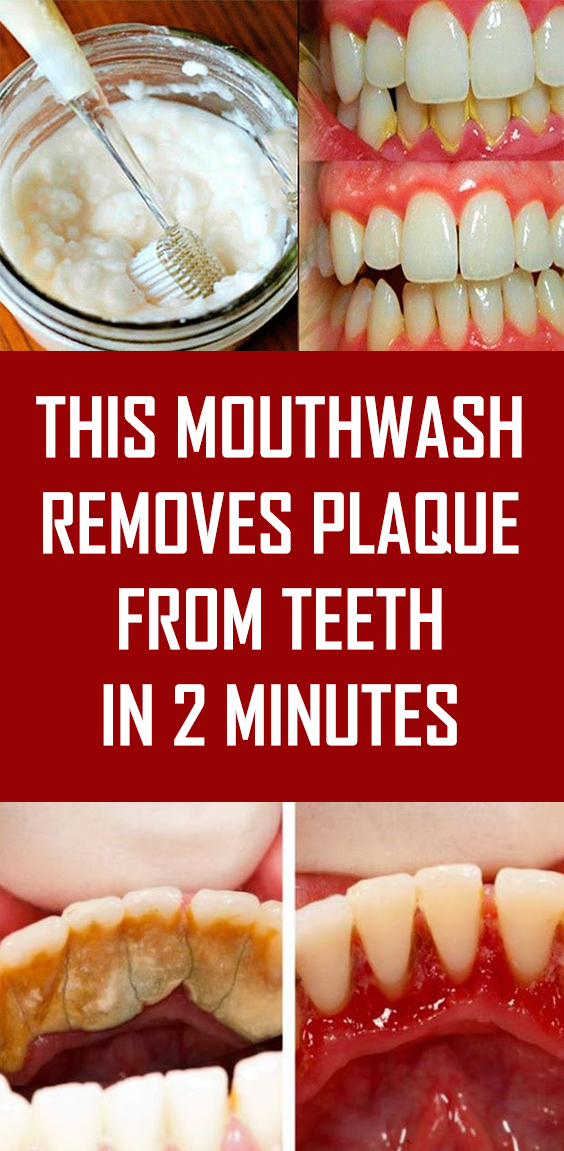Mouthwash Removes Plaque From Teeth In 1 Minute Theraphy 2