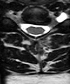 Cervical Perineural Cyst