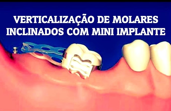 MINI IMPLANTE: Verticalização de Molares Inclinados - Rodrigo Romano