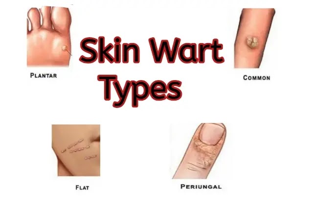 Types of skin wart and the reasons for appearance warts