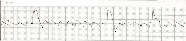 Float Nurse: Megacode PEA Part 2