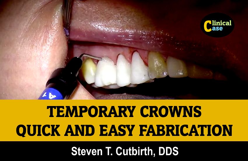 TEMPORARY CROWNS Quick and Easy Fabrication Steven T. Cutbirth, DDS