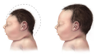Zika virüslü bir bebeğin normal bir bebekten kolayca ayırt edilebilecek en temel farkı