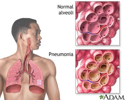 bahaya pneumonia
