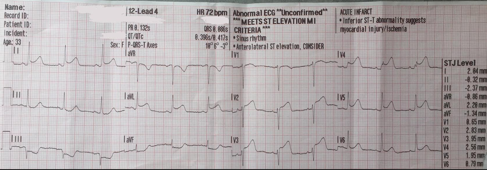 Dr. Smith's ECG Blog 30 yo woman with chest pain and a "normal ECG" by
