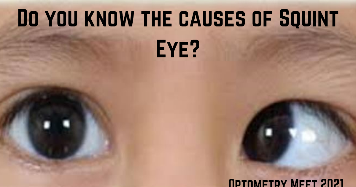 Do you know the causes of Squint Eye?
