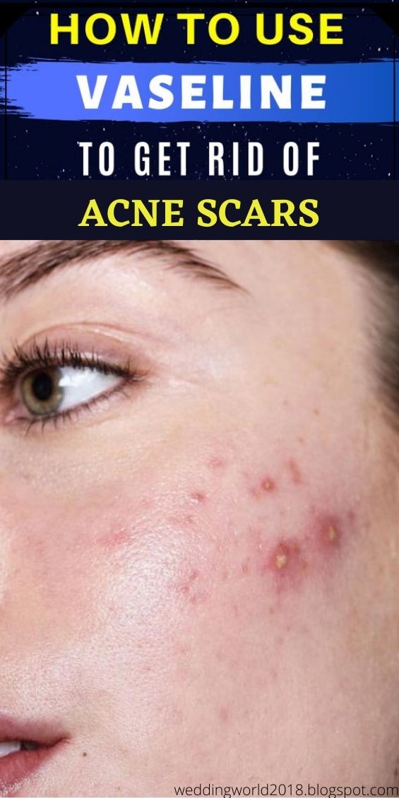 How to Use Vaseline to Treat Acne? WEDDING AND WOMEN LIFE