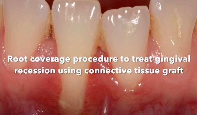 GUM RECESSION SURGERY: Connective Tissue Graft - Dr. Allen