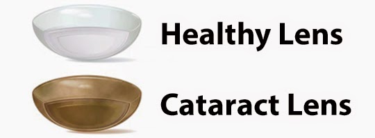 cataract lense