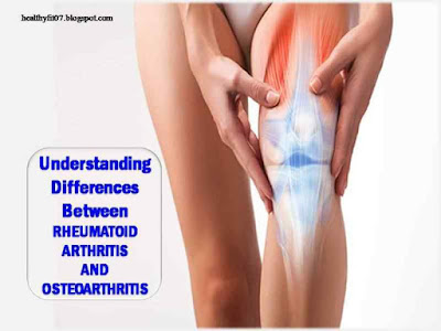 Differences Between Rheumatoid Arthritis and Osteoarthritis