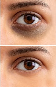 Dark circles kaise hataaye premium Dark circles free me kaise hataaye.