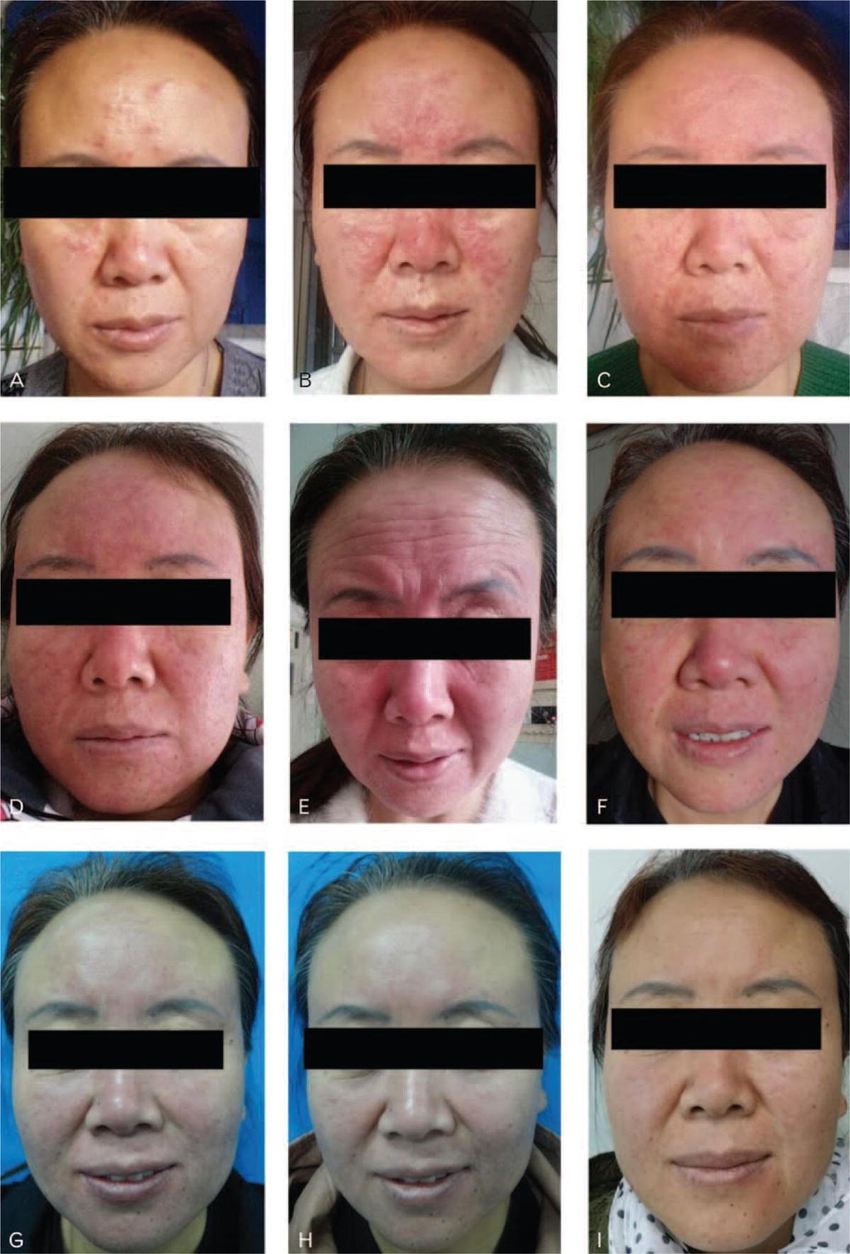 Scarlet Letters, dealing with vascular rosacea, face