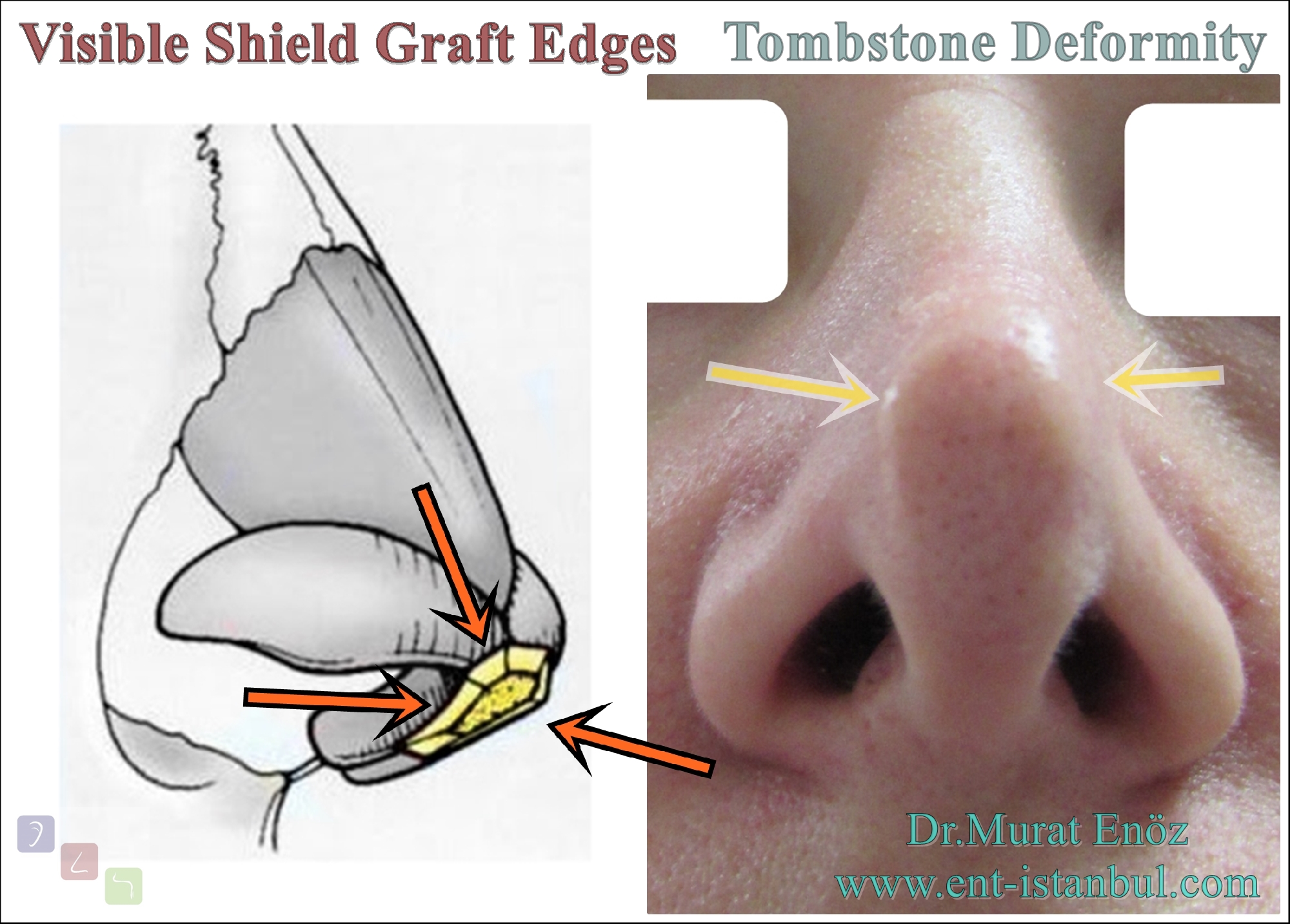 Filler Injection For "Visible Shield Graft Edges Tombstone Deformity"