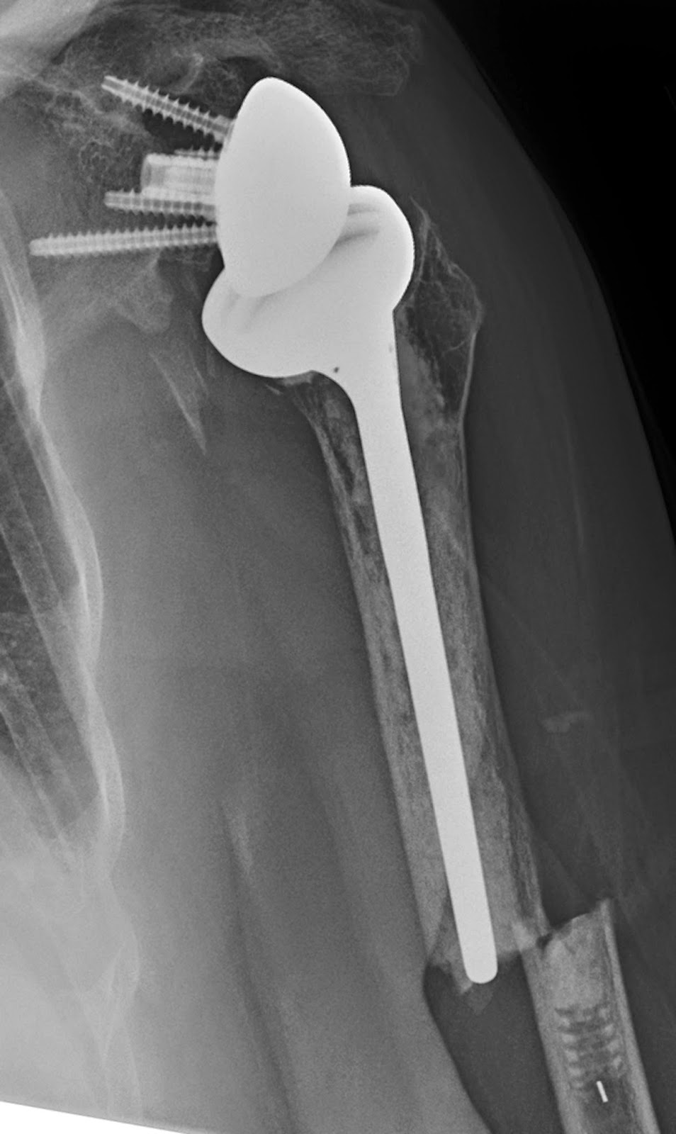 Types of shoulder replacement hardware image