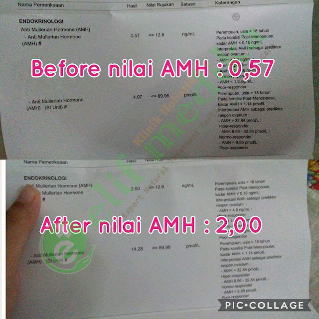 Pengalaman pasien AMH Rendah : AMH sebelum pengobatan 0,57 ng/mL dan setelah 2 bulan pengobatan naik menjadi 2,00 ng/mL. Saat usg transvaginal cadangan sel telur sudah banyak. Pengalaman pasien AMH Rendah : AMH sebelum pengobatan 0,57 ng/mL dan setelah 2 bulan pengobatan naik menjadi 2,00 ng/mL. Saat usg transvaginal cadangan sel telur sudah banyak.