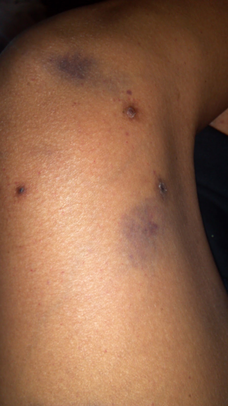 Bruises and Blood Spots Under the Skin | Michigan Medicine