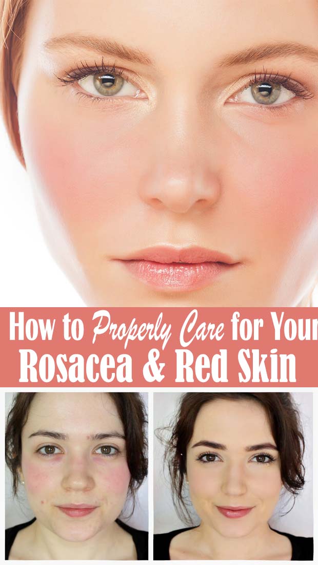 How to Properly Care for Your Rosacea & Red Skin Healthy Lifestyle