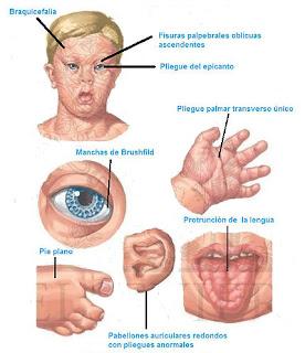 SINDROMES GENÉTICOS : TRISOMÍA DEL CROMOSOMA 21