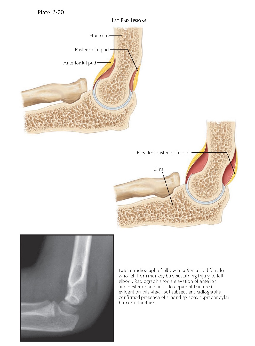 INJURY TO THE ELBOW - pediagenosis