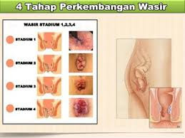 Wasir Ambeien Tingkat Keparahan Stadium 1 - 4