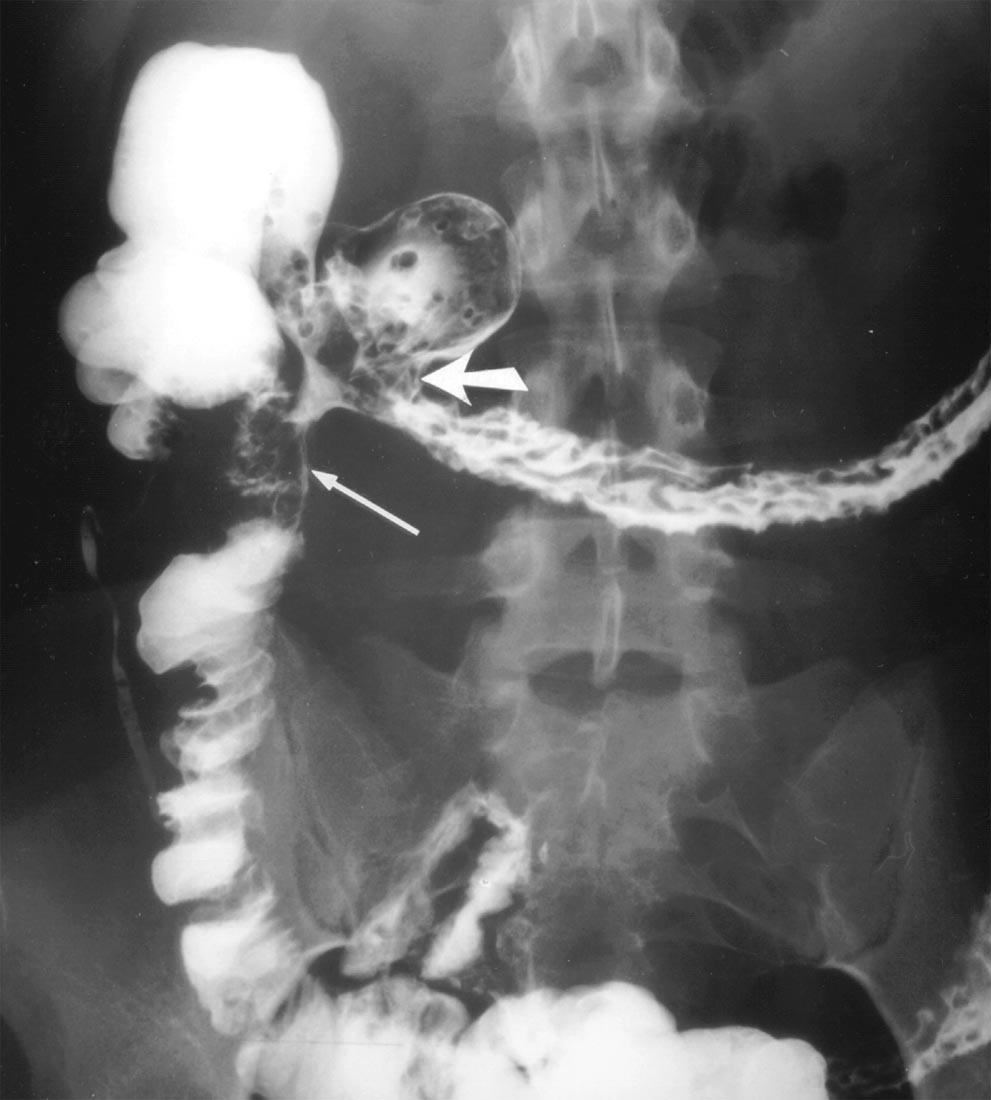 Common Diagnostic of Barium Xray Studies