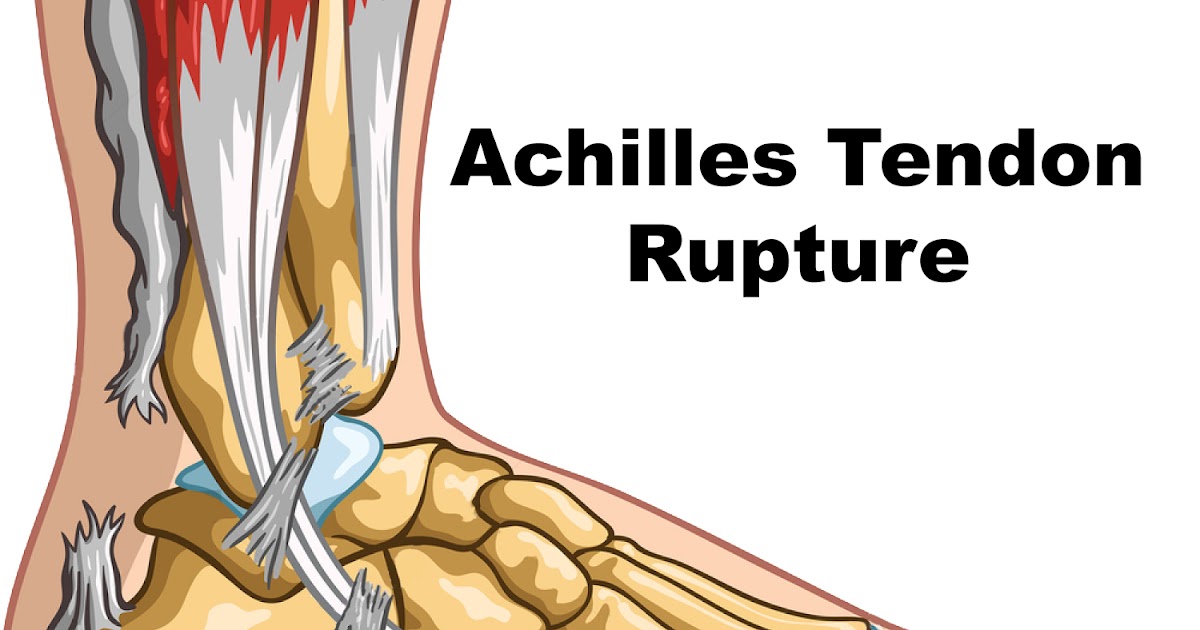 Achilles Tendon Ruptures: The Science