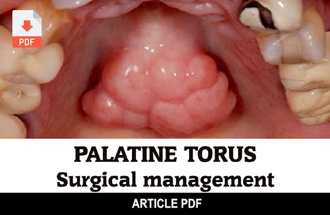 PDF: Surgical management of Palatine Torus