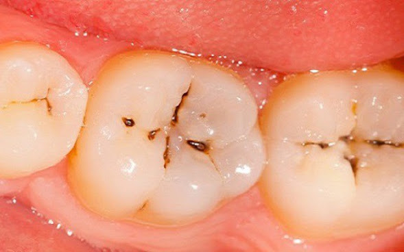 Why do cavities hurt