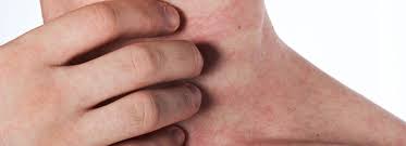 gejala biang keringat ruam biang keringat gatal