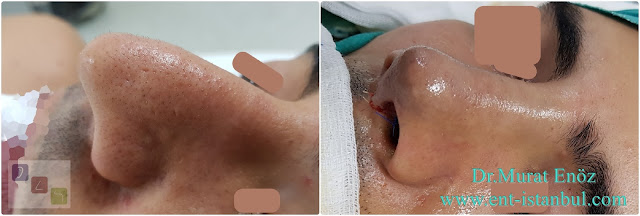 Male Nose Aesthetic Surgery,Men's Rhinoplasty in Istanbul,Rhinoplasty in Men Istanbul,Nose Job Surgery For Men in Istanbul,Male Nose Operation in Turkey,