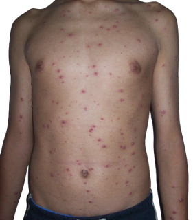 Chicken pox ( छोटी माता ) चेचक के कारण और लक्षण