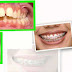 Trường hợp niềng răng nào phải nhổ răng?