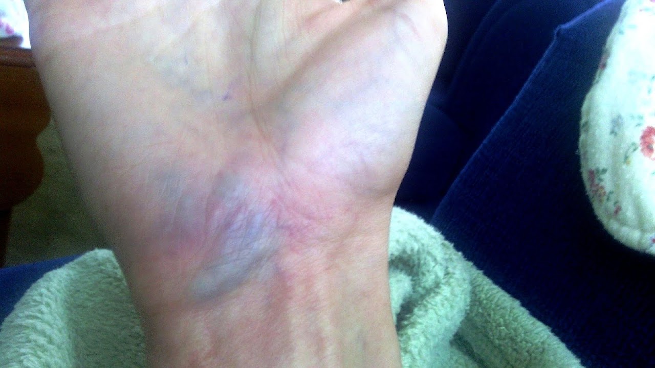 Blue Veins In Hands Blue Choices