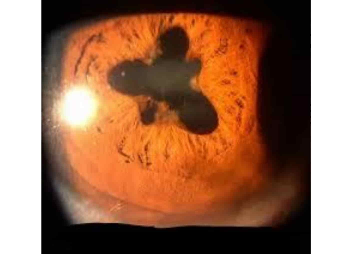 Short cases in ophthalmology