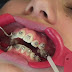 Tác hại khi niềng răng sai cách là gì? 