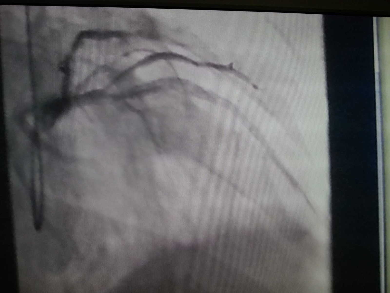 11回目の経皮的冠動脈形成術