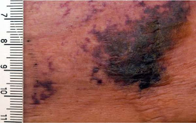 5 Signs of Calciphylaxis, Skin Damage Due to Calcium Accumulation