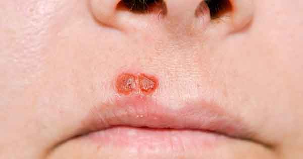 Penyebab Dan Cara Mengobati Herpes Obat Herpes Paling Manjur