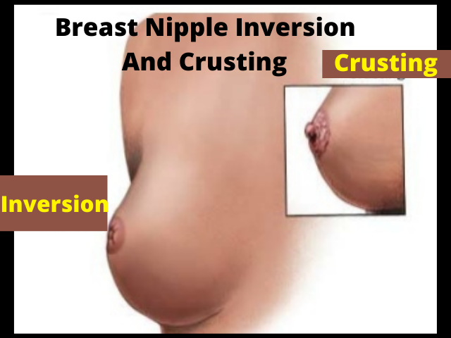 nipple inversion nipple inversion