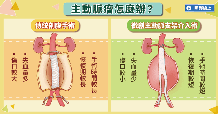 主動脈瘤怎麼辦