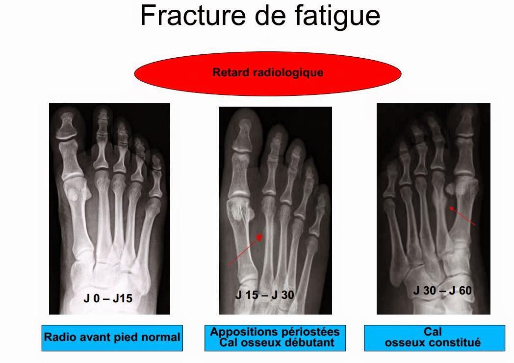 Un médecin du sport vous informe Les fractures de fatigue (de stress