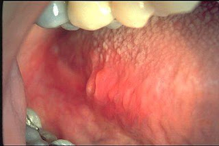 lingual tonsils Pain, Enlarged, Bumps, Swollen, Removal 