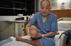 centipede bite leg amputated amputee guy below dogs half ong blame know