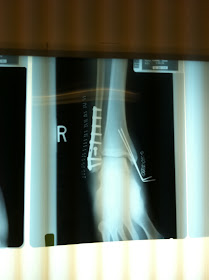 Broken Ankle - Trimalleolar Ankle Fracture