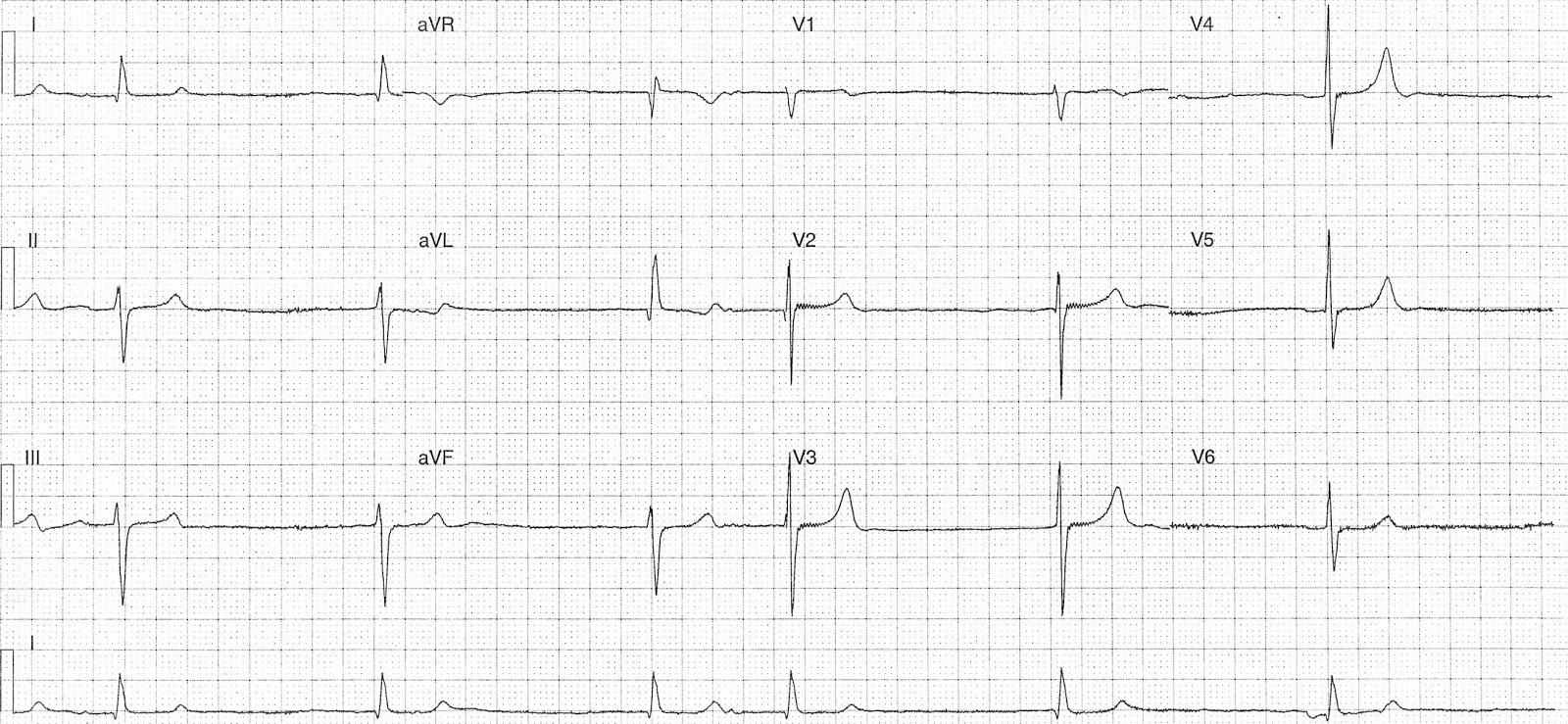ECG Of The Week ECG Of The Week 10th August 2015 ecg-of-the-week-ecg-of-the-week-10th-august-2015