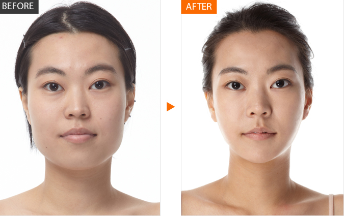 plastic surgery in korea face contouring two jaw surgery what s