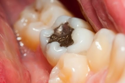 Mal de dents après remplissage